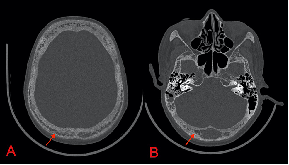 CT-scans-of-the-calvaria-(A)-and-skull-base-(B)-in-the-bone-window-show-diffuse-spotty-osteopenia-with-salt-and-pepper-morphology