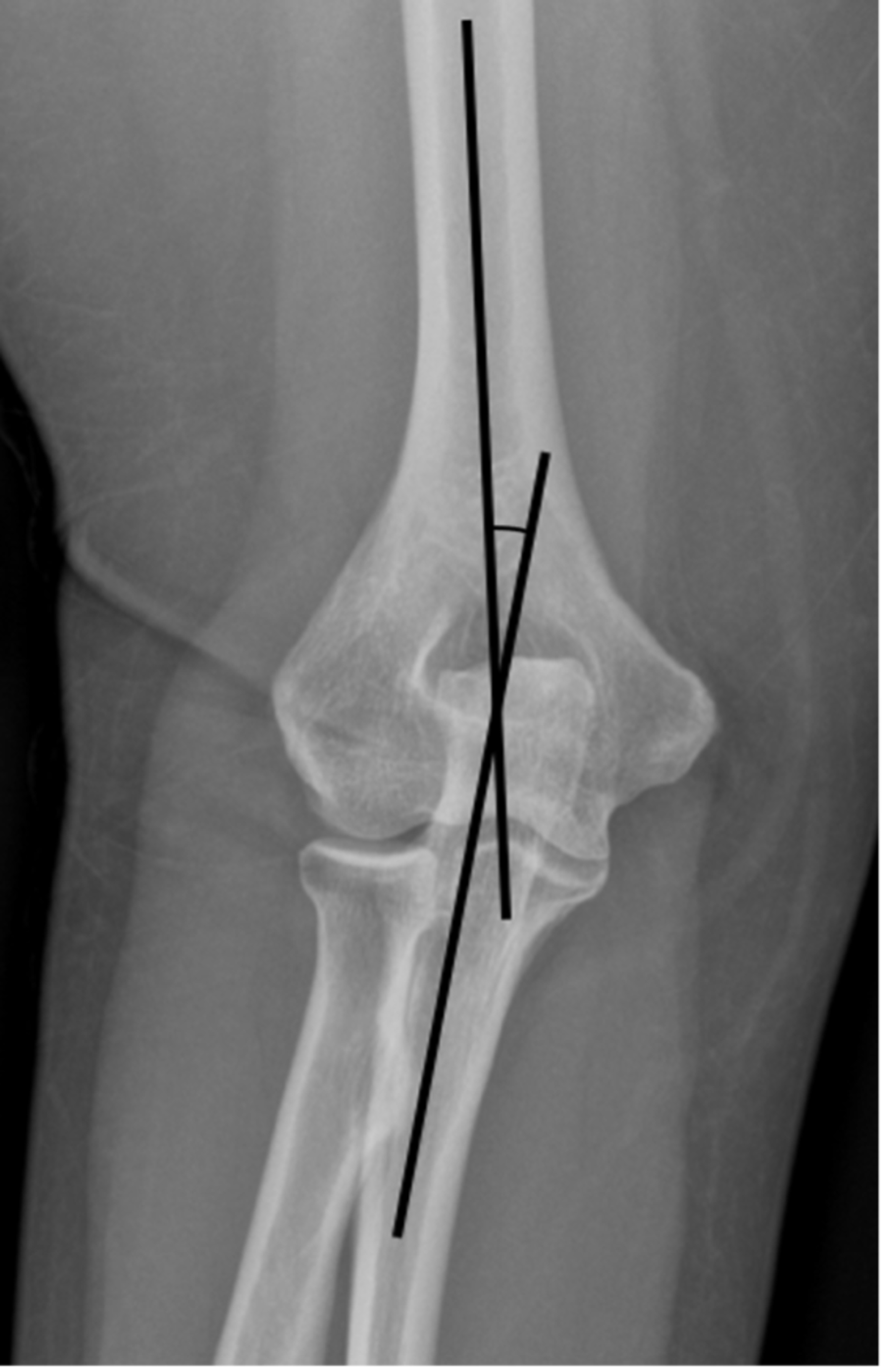 Cureus Association Between Increased Elbow Carrying Angle and Lateral