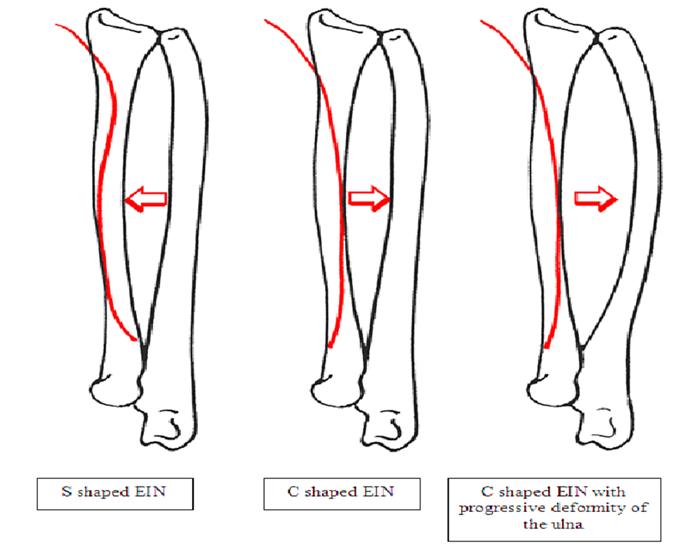 Cureus Single Versus Double Intramedullary Fixation of Paediatric Both Bone Forearm Fractures