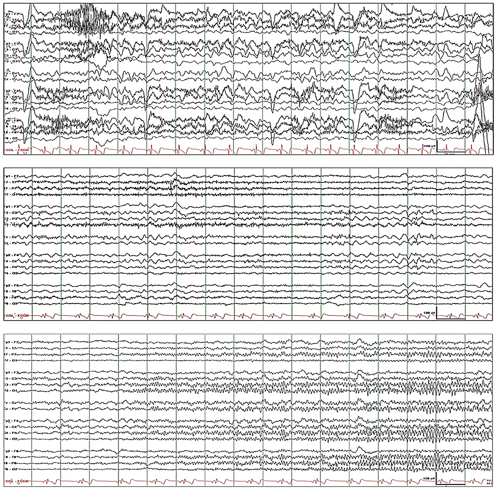 Cureus | Electroclinical Mismatch During EEG Acquisition: What It Might  Mean, What We Might Need to Do | Article