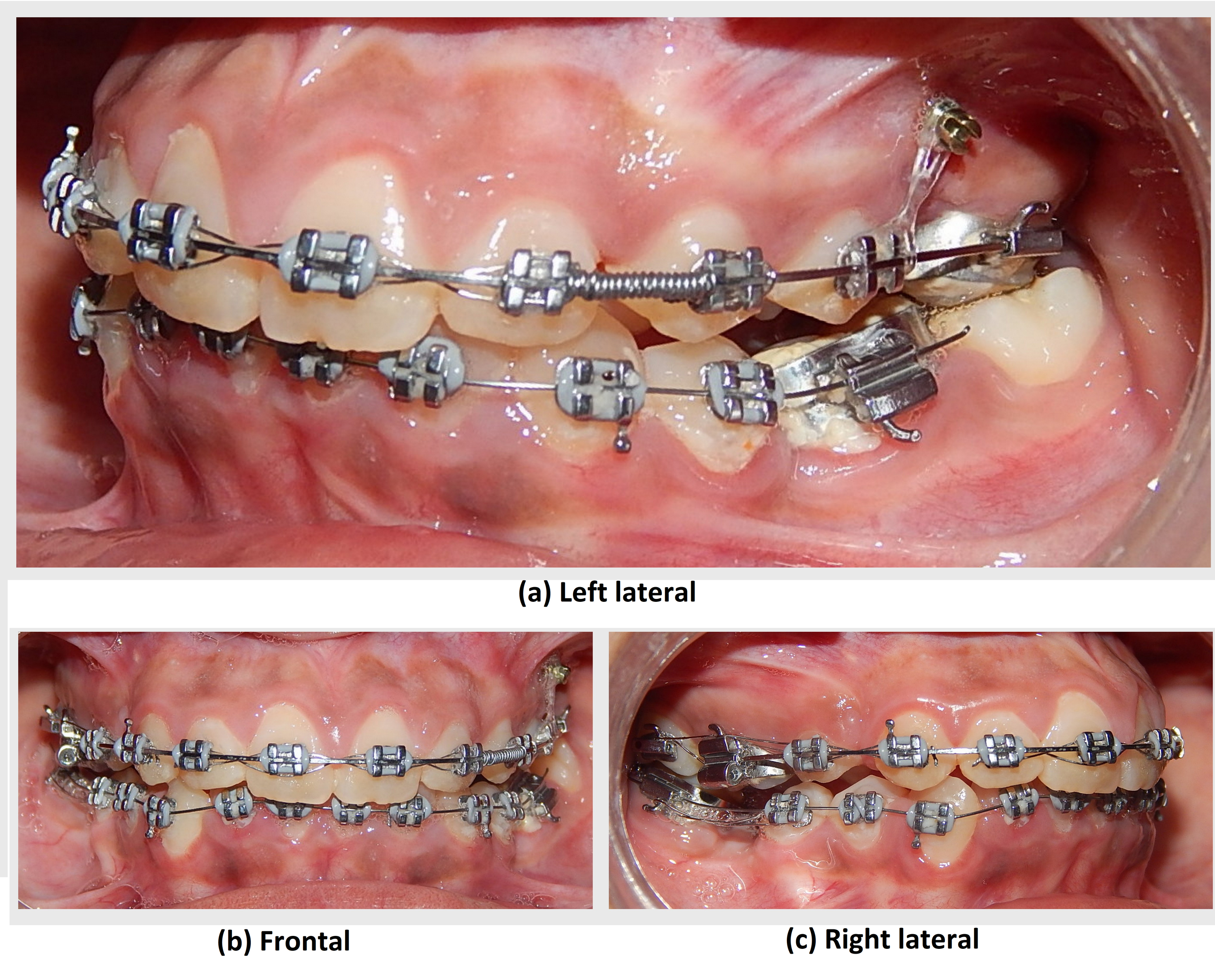 Cureus Orthodontic Treatment Of A Case With Palatally Impacted Canine And Missing Molars A Case Report Cureus Orthodontic Treatment Of A Case With Palatally Impacted Canine And Missing Molars A Case Report