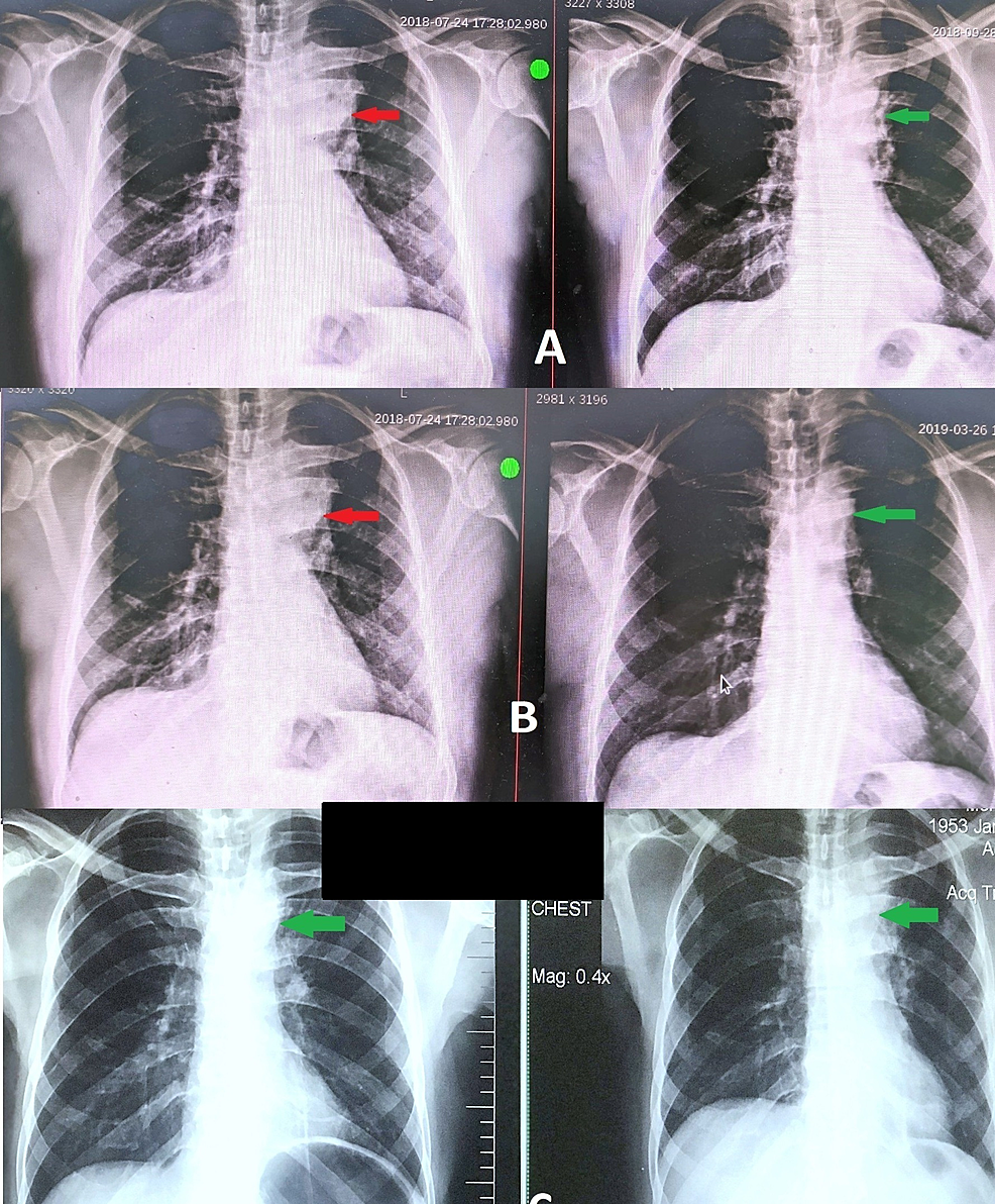 Chest-X-ray-images.