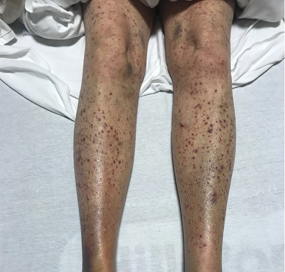 Image-depicting-the-non-palpable-petechia-on-bilateral-lower-extremities-and-blue-ecchymosis-on-bilateral-ankles