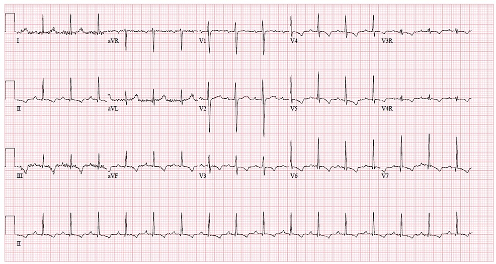 End-of-scenario-ECG-showing-normal-sinus-rhythm