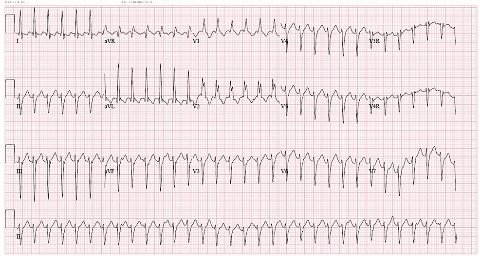 -Initial-ECG-showing-wide-complex-tachycardia-with-signs-of-left-axis-deviation-and-right-bundle-branch-block-consistent-with-Belhassen-tachycardia