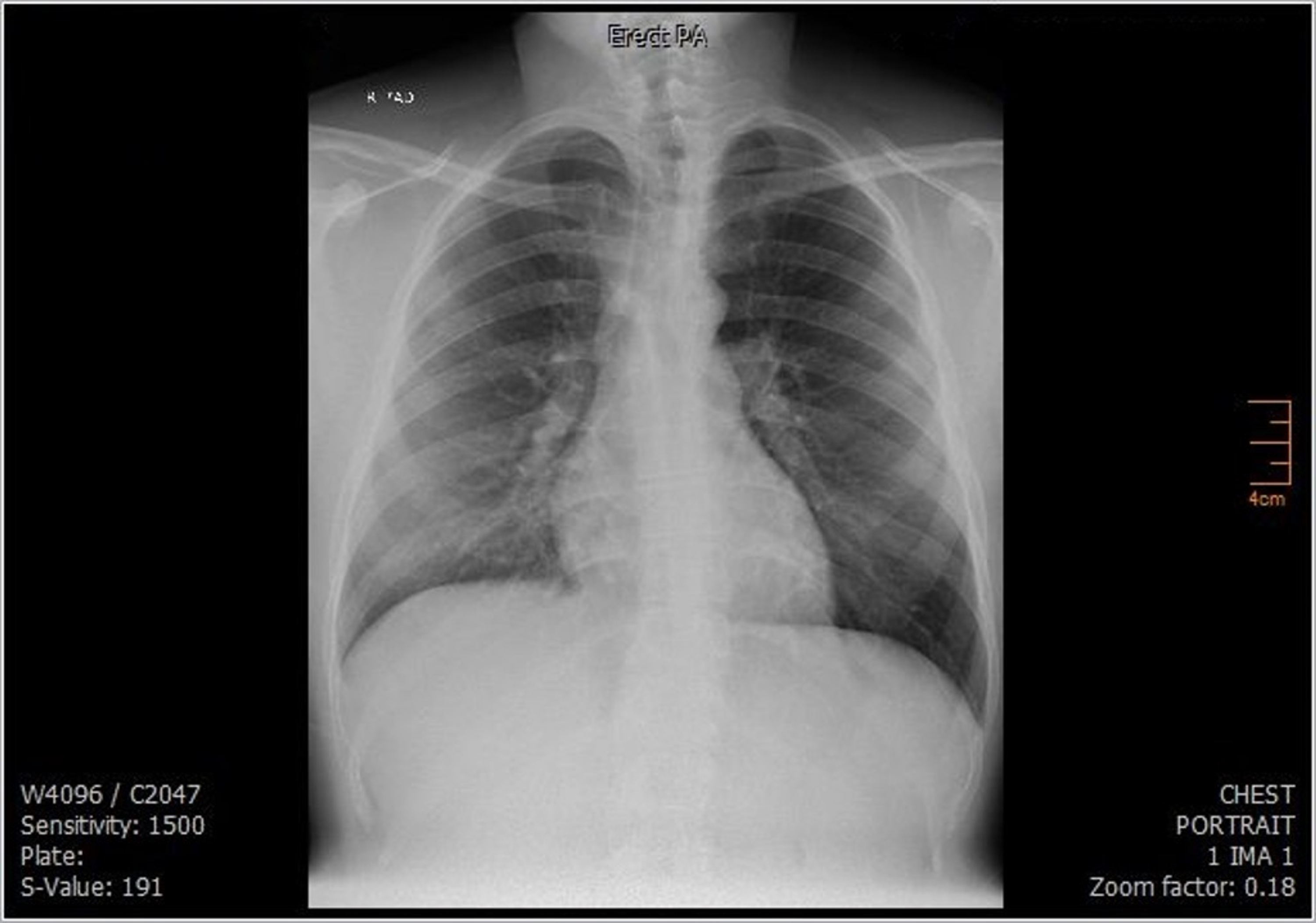 Cureus | Two Adults With Multisystem Inflammatory Syndrome Post-COVID ...