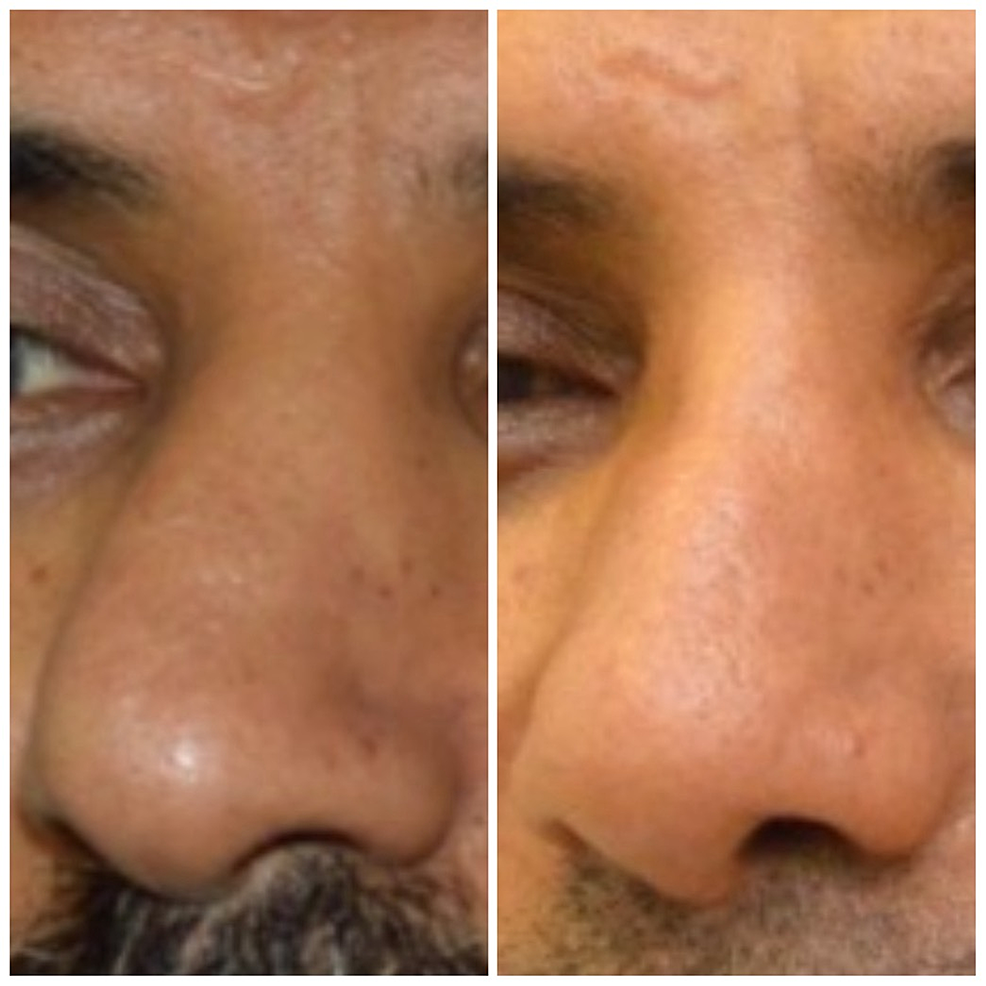 Before-and-after-the-rhinoseptoplasty.