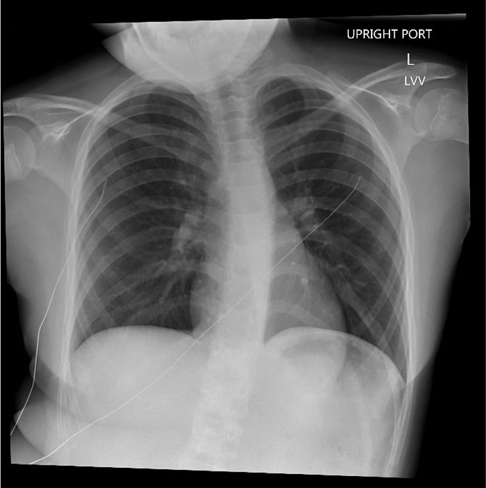 Normal-chest-X-ray