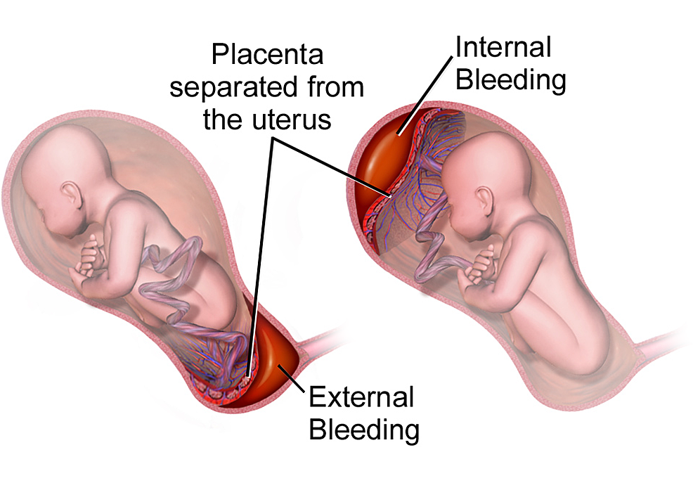Placental-abruption.
