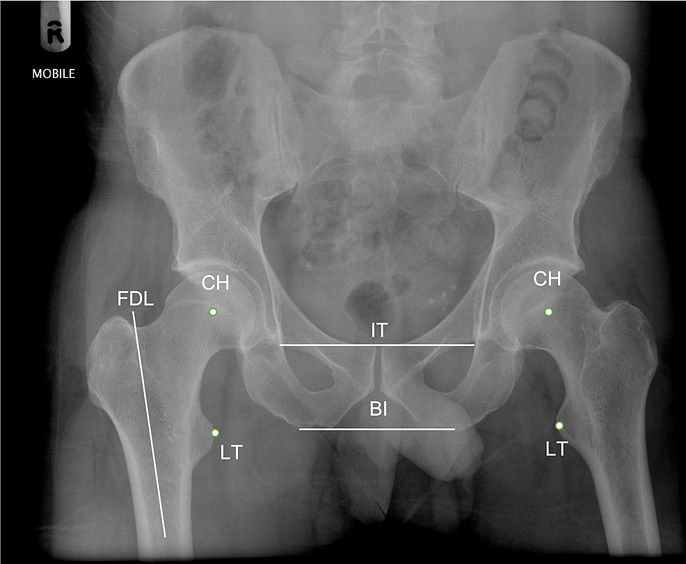 Hip X-ray in anteroposterior incidence showing measurement of the