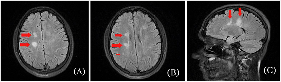 T2-weighted-MRI-images-of-the-brain.-A-&-B:-Axial-images-of-brain-MRI-demonstrating-several-foci-of-FLAIR-hyperintensities-(red-arrows);-C:-Sagittal-image-of-brain-MRI-showing-large-FLAIR-in-right-posterior-frontal-lobe-measuring-1.4-cm-(red-arrow).