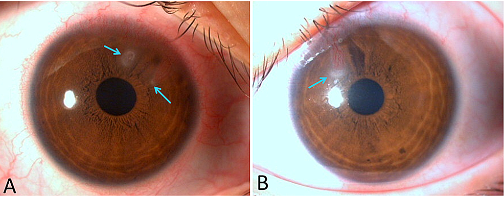 PDF) Management of severe Acanthamoeba keratitis and complicated cataract  following laser in situ keratomileusis