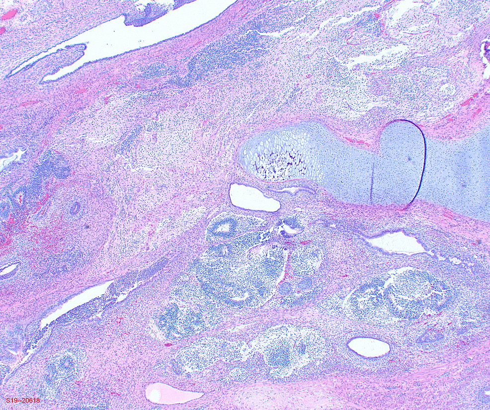 Cureus | Immature Teratoma With Metastatic Gliosis