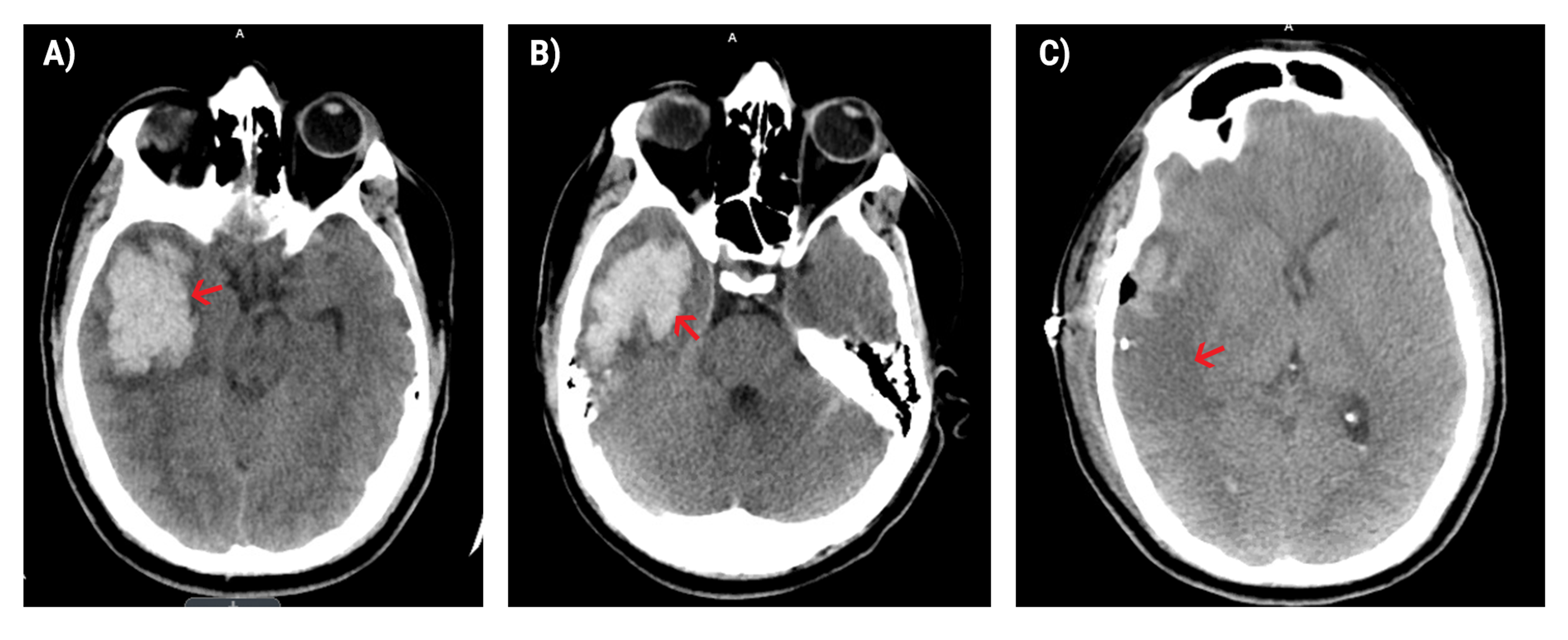 Cureus | Intracranial Hemorrhage Secondary To Newly Diagnosed Acute ...