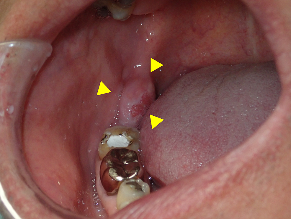 Intraoral-photograph-showing-the-tumor-in-the-retromolar-pad-area