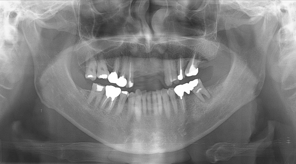 Orthopantomograph-showing-the-right-mandible-without-any-bony-invasion-of-the-tumor