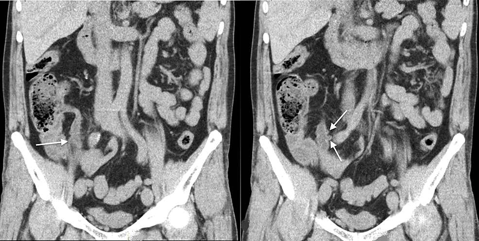 Cureus Appendiceal Diverticulitis Presenting As Acute Appendicitis