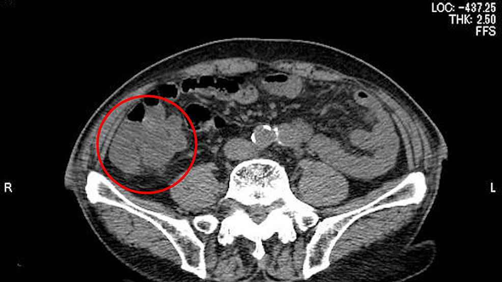 The-abdominal-computed-tomography-showing-the-edematous-lesions-in-the-small-intestine-and-colon-(red-circle).