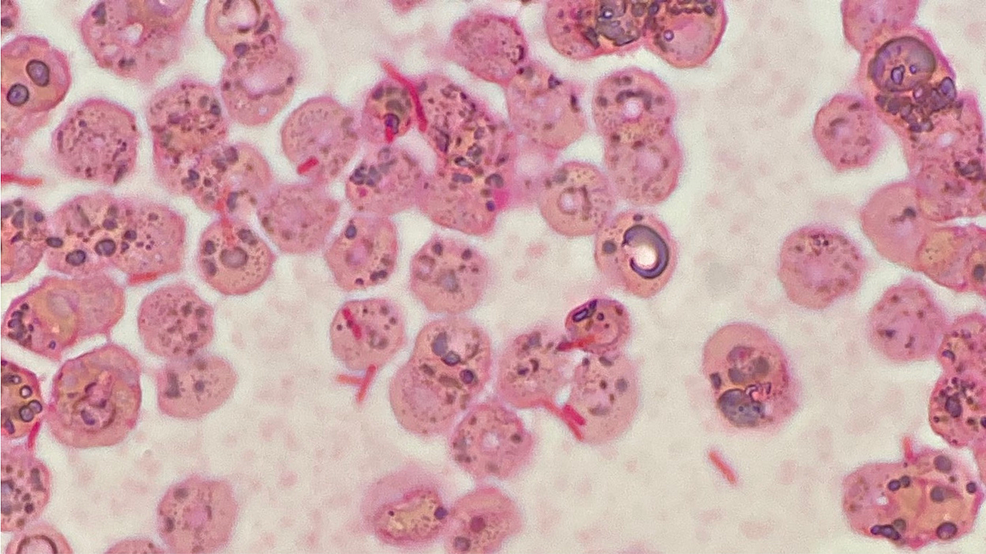 The-gram-stain-of-the-patient’s-blood-culture.