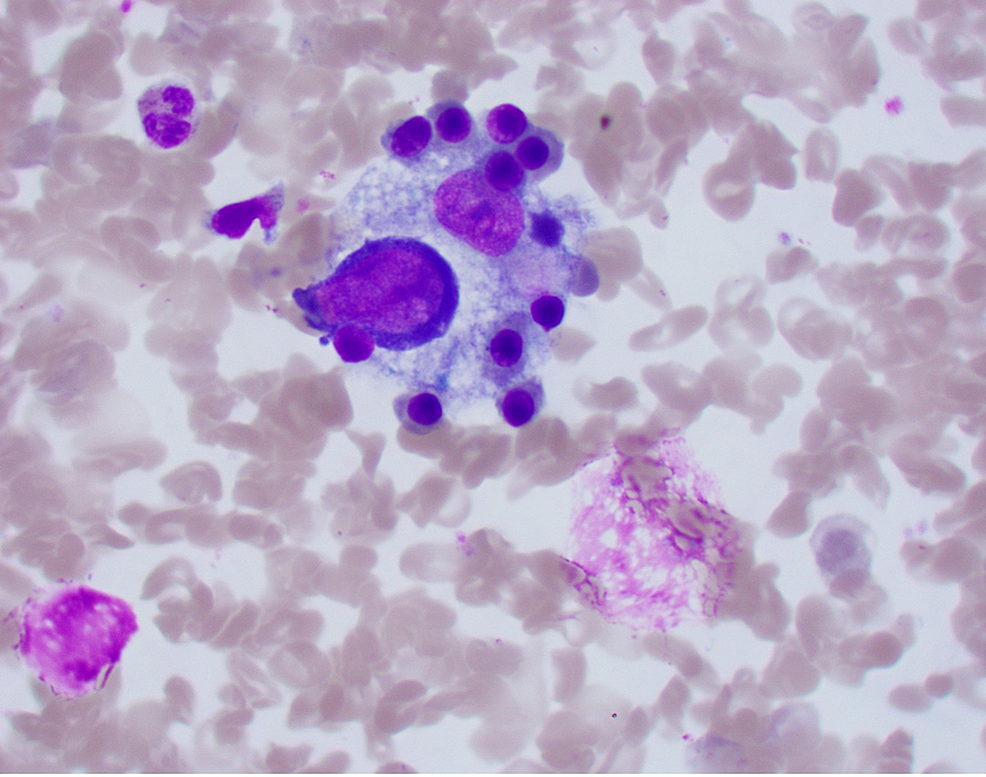 Bone-marrow-aspirate