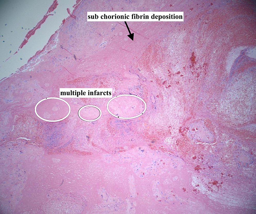 Multiple-placental-infarcts-and-sub-chorionic-fibrin-deposition