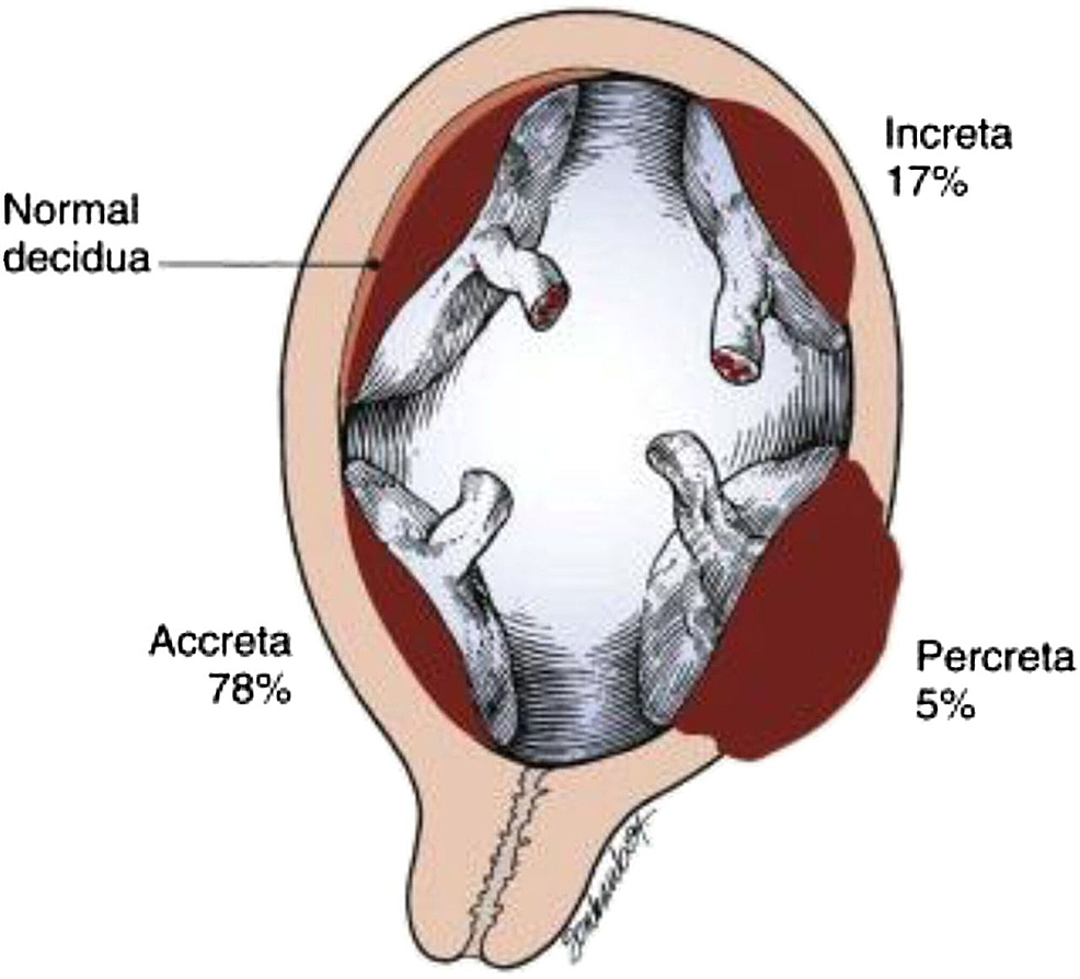 cureus-early-accreta-and-uterine-rupture-in-the-second-trimester