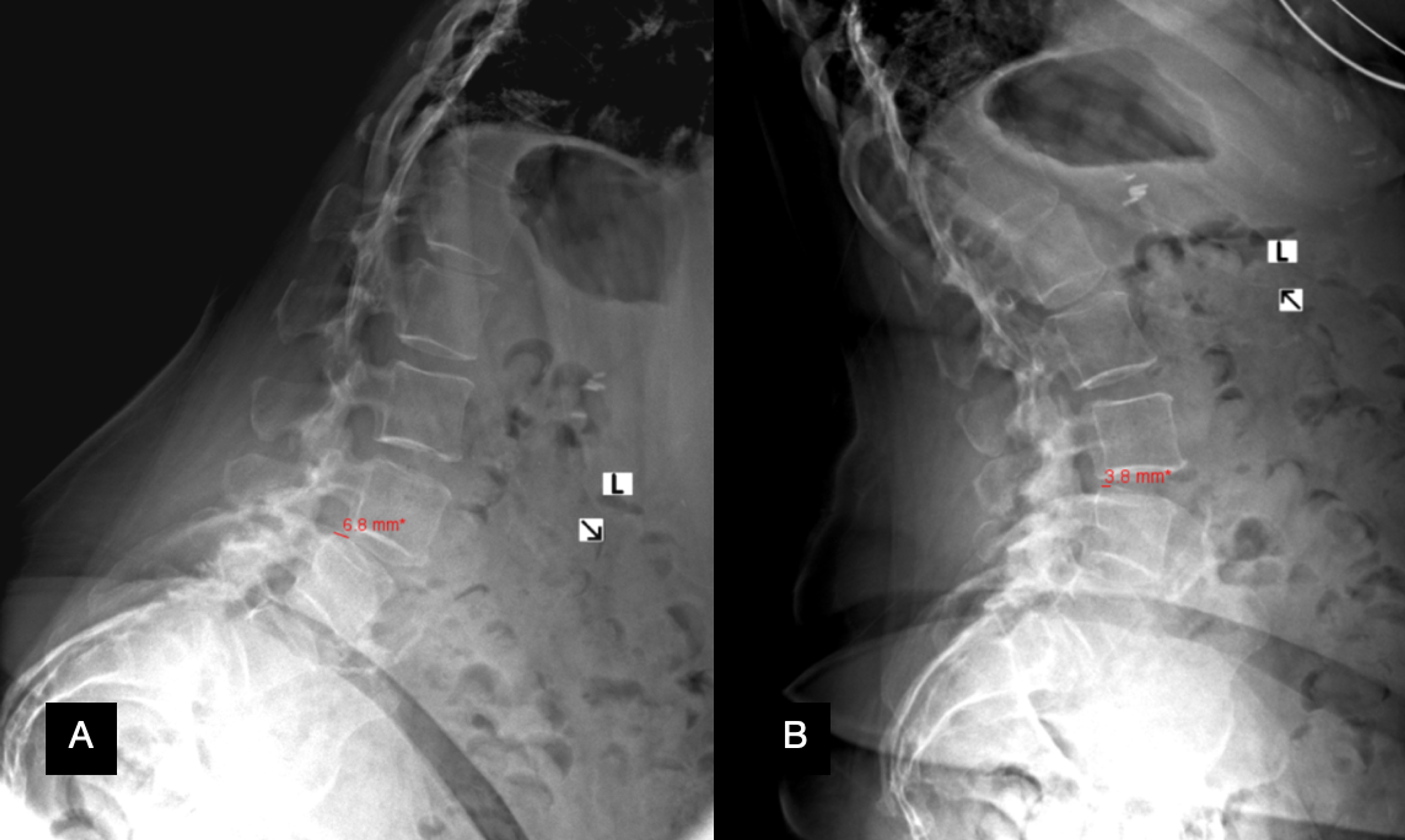 lumbar spine xray