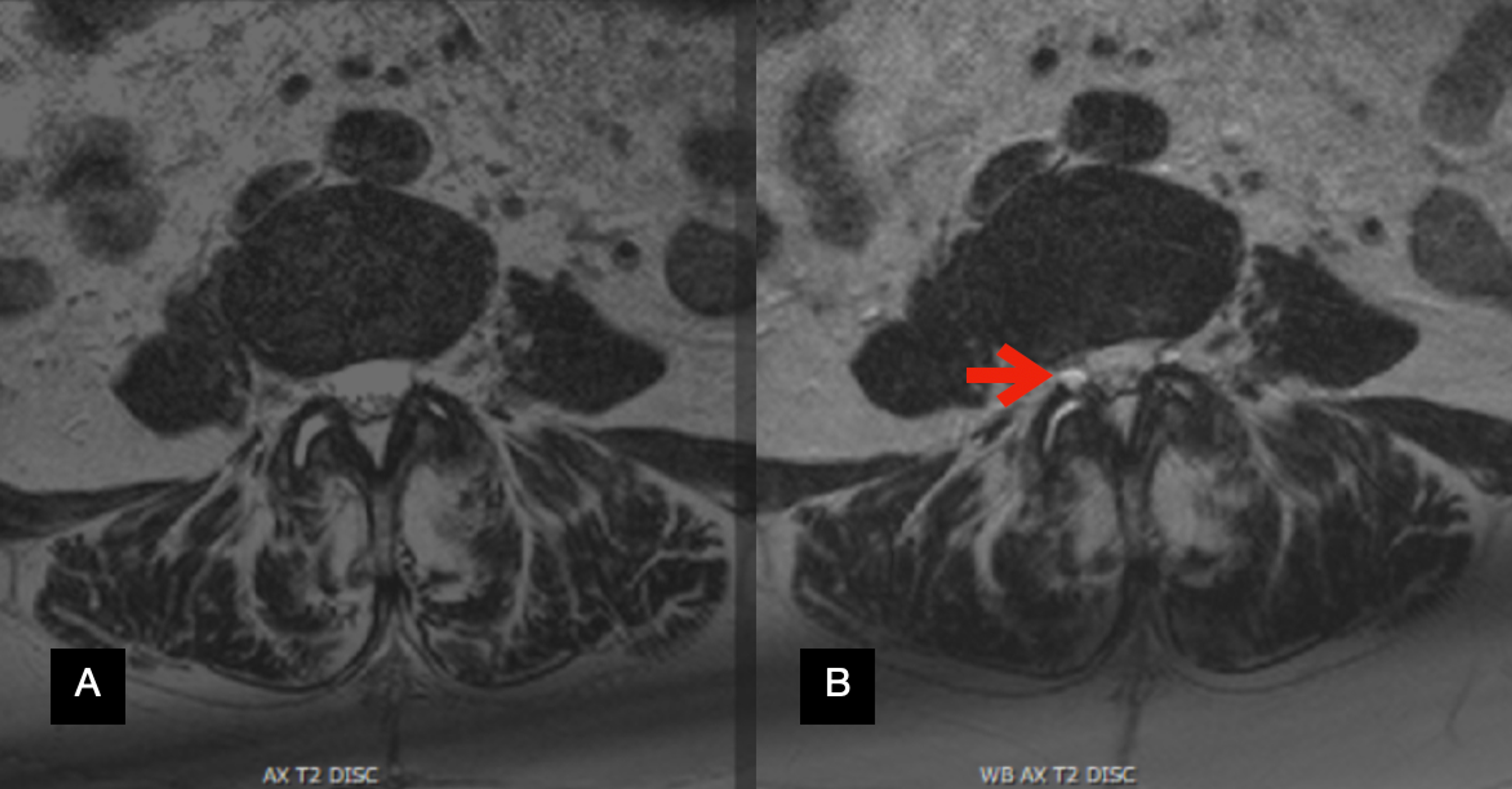 Cureus Utility of WeightBearing MRI in the Lumbar Spine A Novel