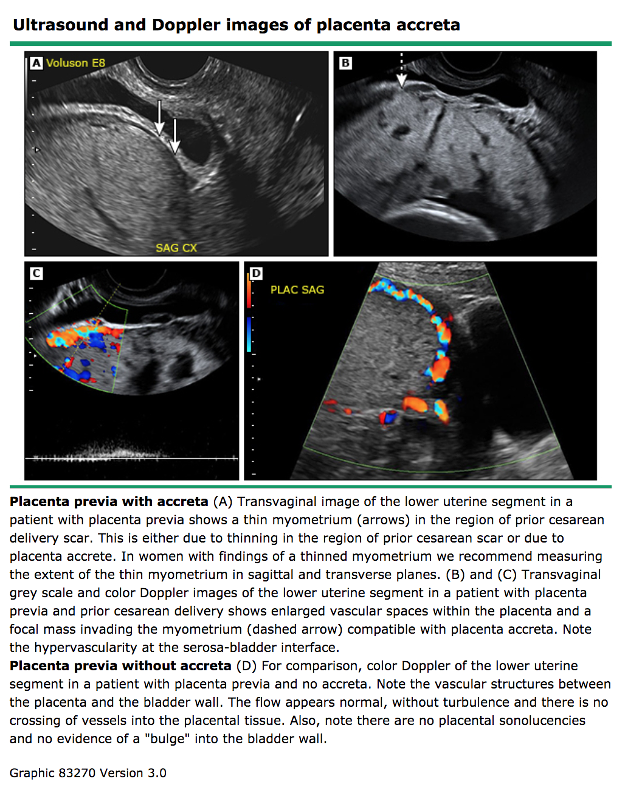 placenta-percreta-ultrasound