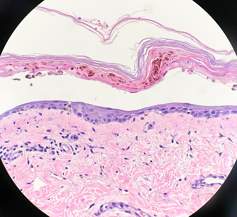 Cureus | A Life-Threatening Case of Torsemide-Induced Toxic Epidermal ...