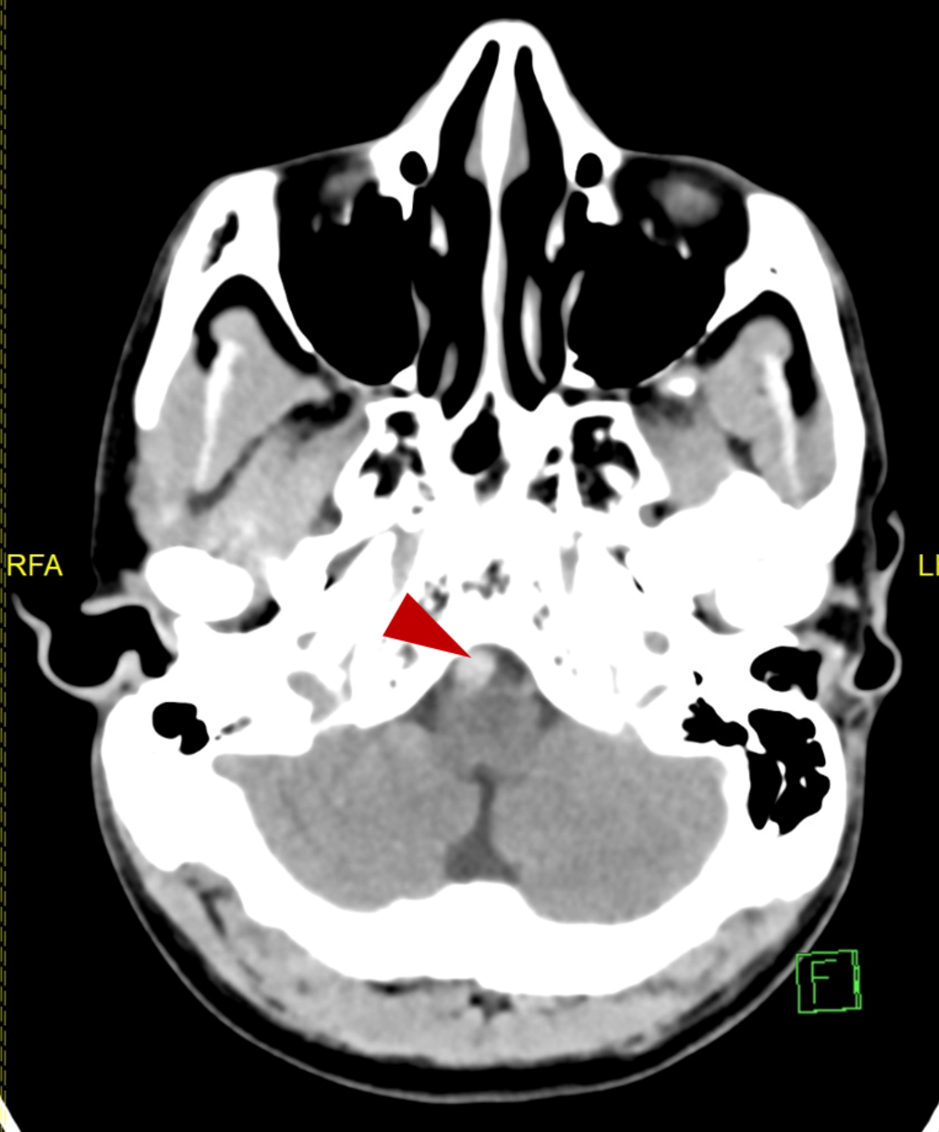 lateral pontine syndrome mri