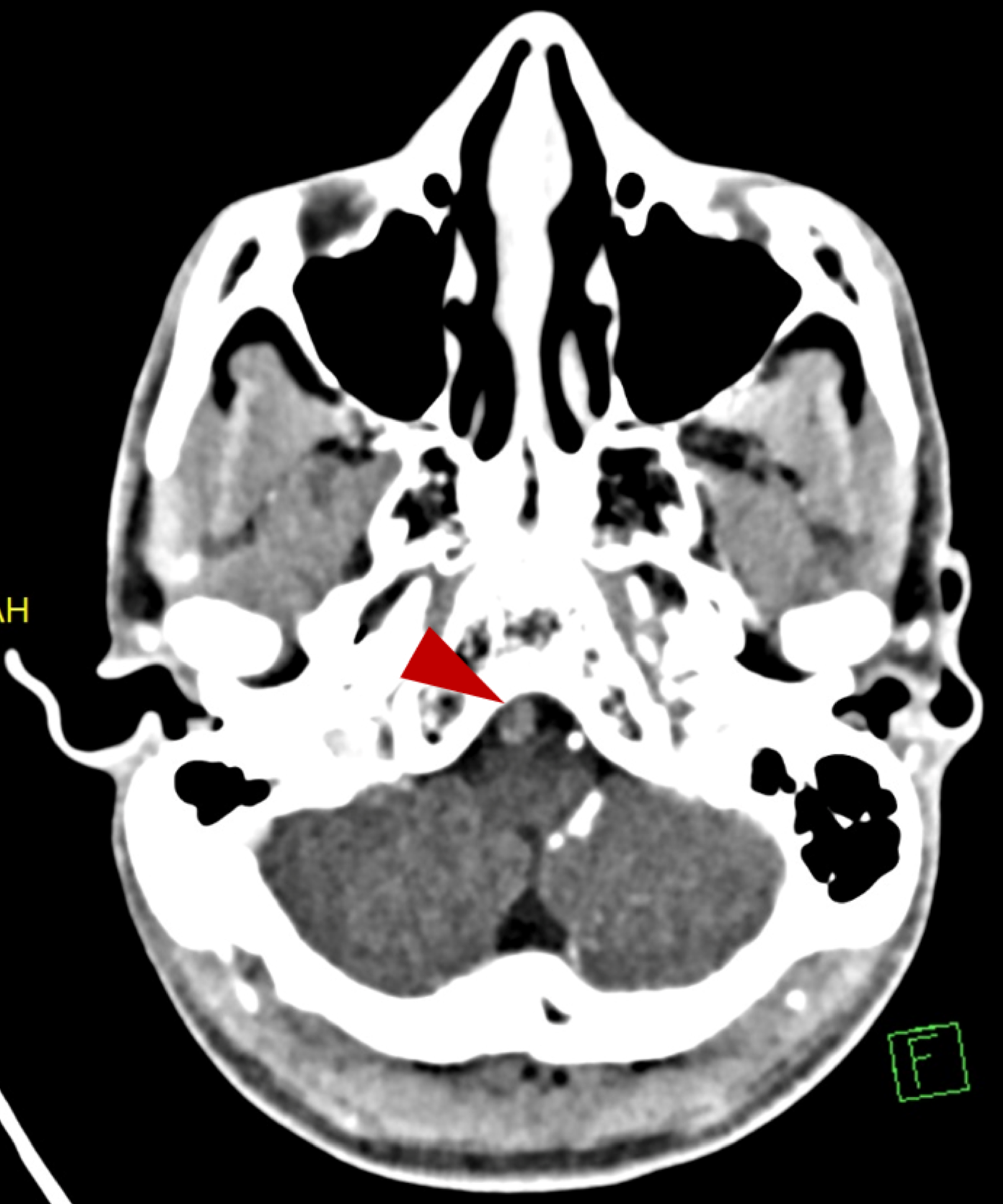 Cureus Late Diagnosis Of A Patient With Gradual Onset Of Lateral Medullary Syndrome Secondary