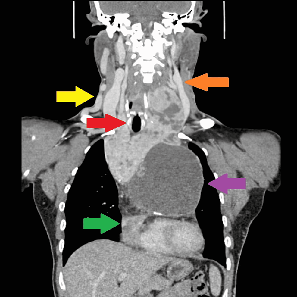 A Monster in the Chest A Tale of a Goiter Cureus