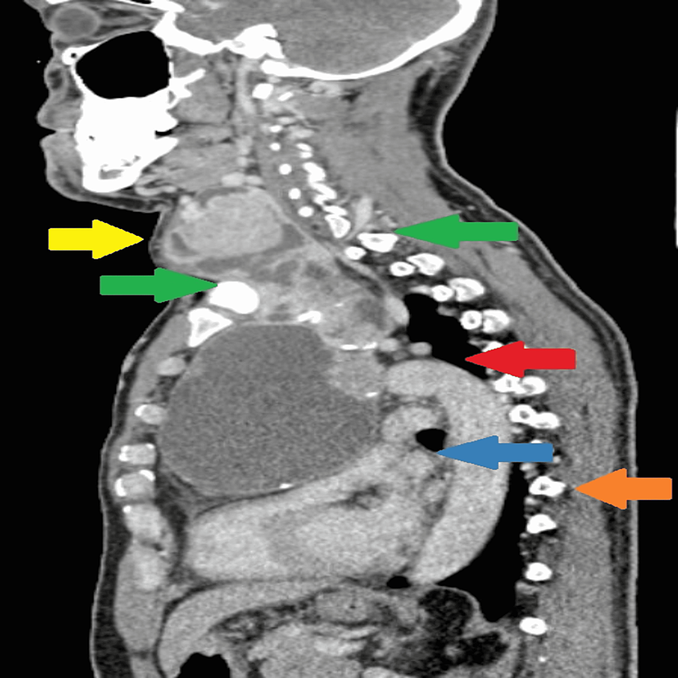 CT-(sagittal-plane)-of-the-goiter-extending-below-thoracic-inlet-into-mediastinum.
