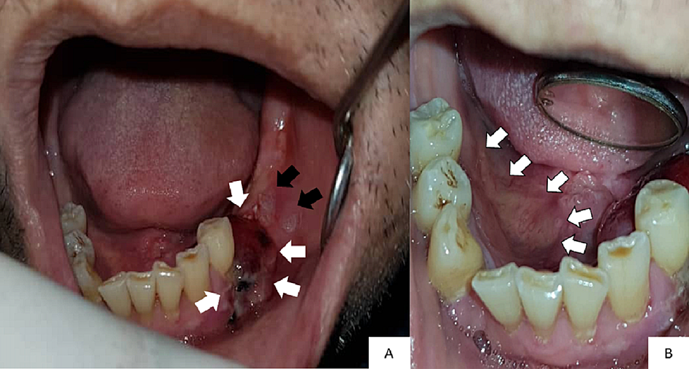 Intraoral-photographs-show-(A)-a-swelling-in-the-lower-left-premolar-molar-region-(white-arrows)-and-two-white-patches-(black-arrows)-and-(B)-an-irregular-ulcer-on-the-right-side-of-the-floor-of-the-mouth-(white-arrows)