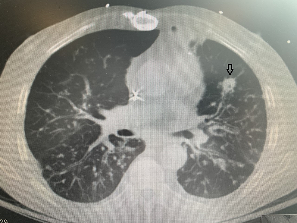 -CT-chest-without-contrast
