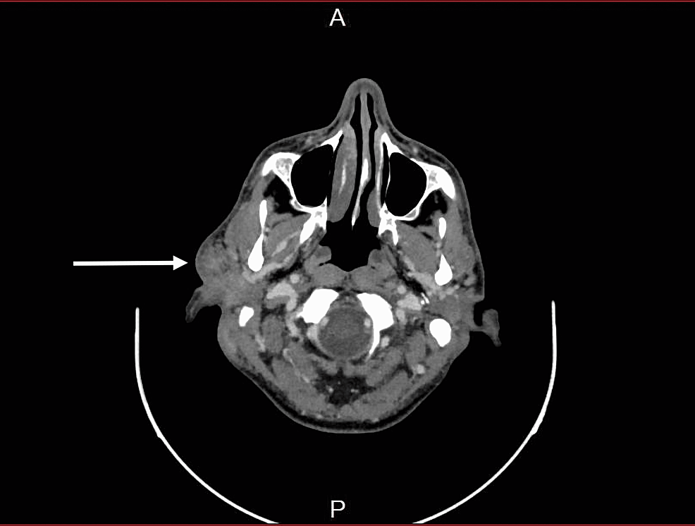 CT-showing-enlarged-heterogeneous-right-parotid-gland