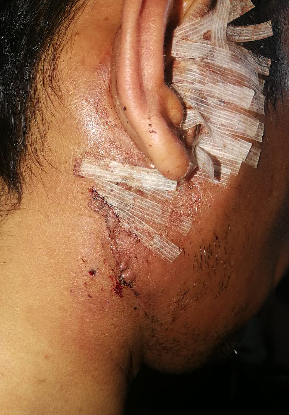 Image-on-the-first-postoperative-day-showing-clean-wound-and-intact-facial-nerve