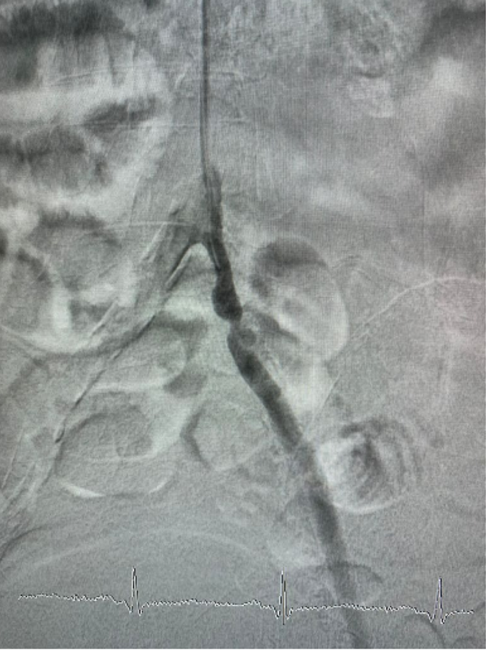 Arteriography-in-the-left-leg