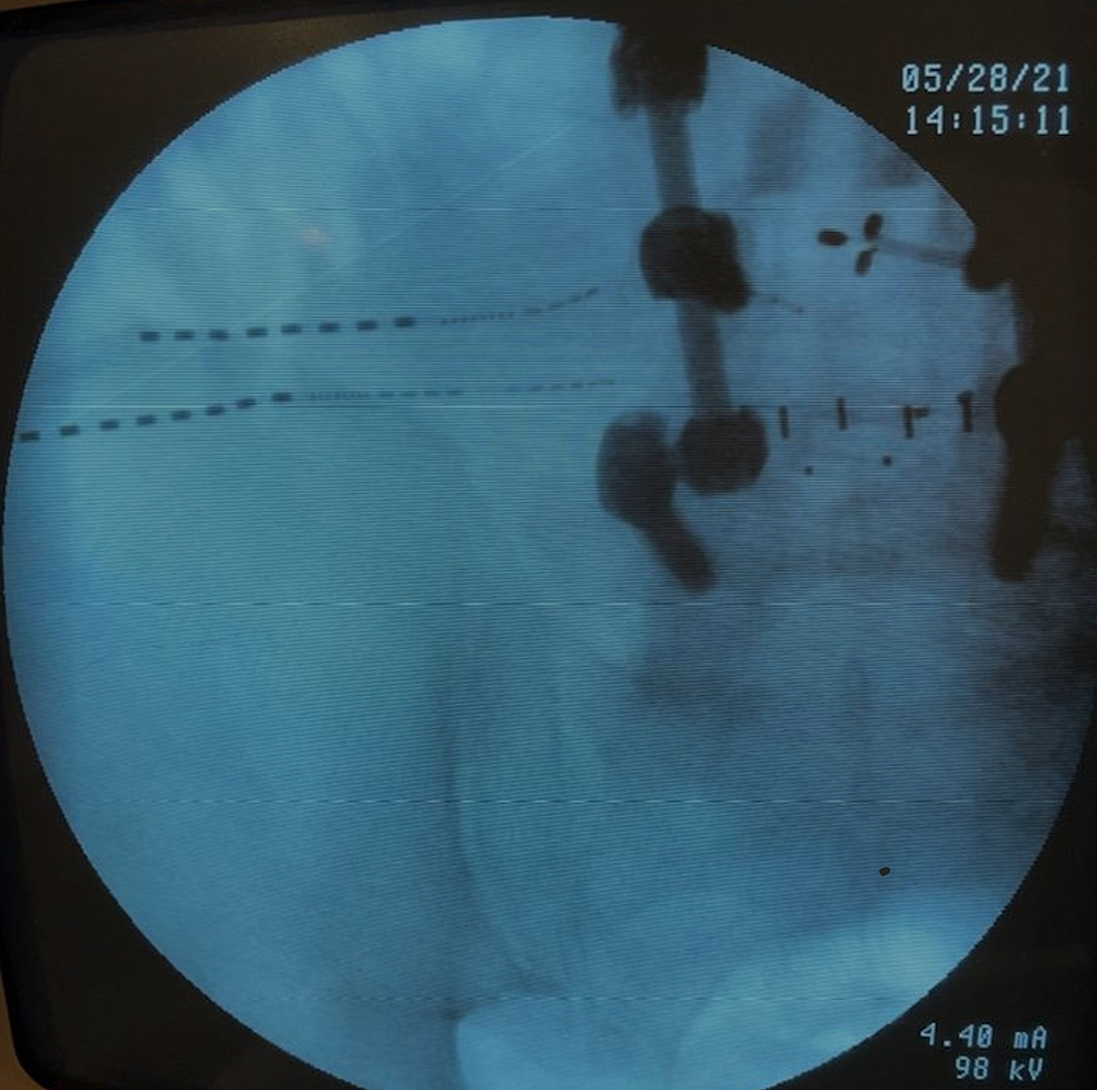 Stimwave, Peripheral Nerve Stimulation for Chronic Pain — Advanced  Diagnostic Pain Treatment Centers