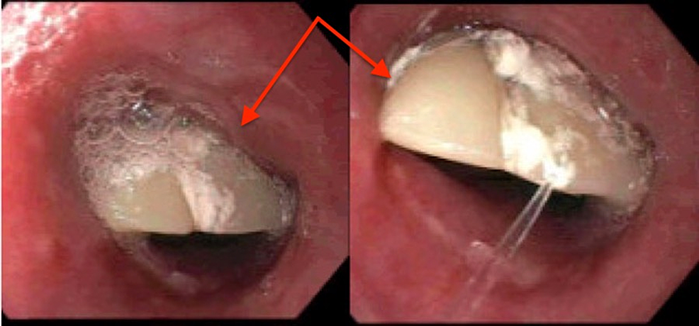 Dentadura postiza parcial observada en las porciones superior (izquierda) y media (derecha) del esófago. Flechas apuntando a la dentadura postiza.
