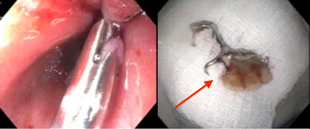 The-left-image-demonstrates-the-area-of-the-esophagus-where-the-denture-was-previously-sitting-and-the-right-image-showed-the-denture-itself-after-successful-removal.-Arrow-pointed-at-denture-after-removal.