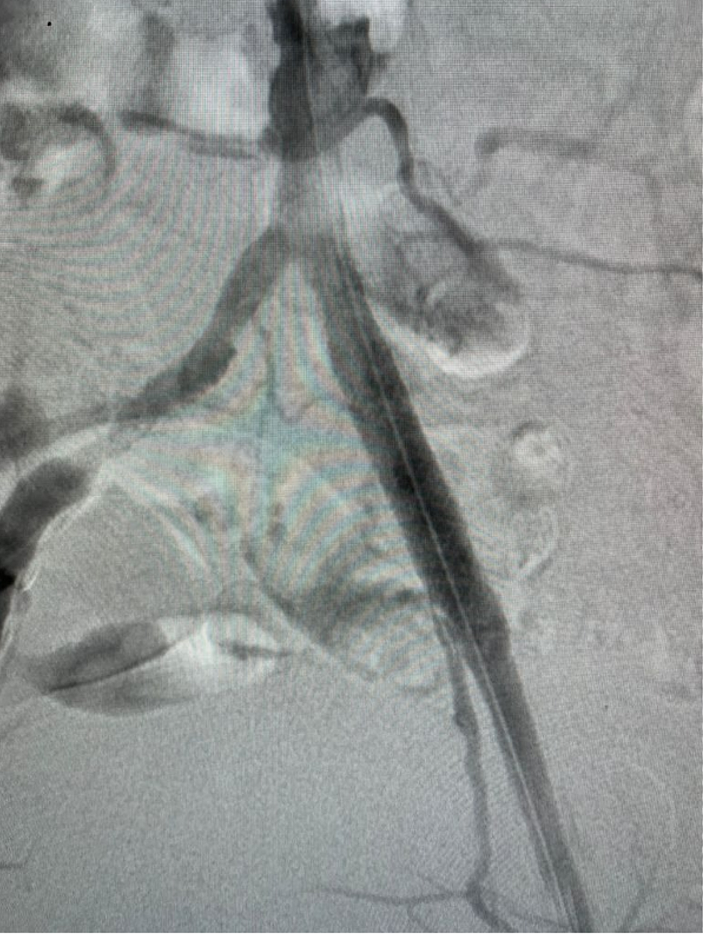 Result-of-endovascular-treatment