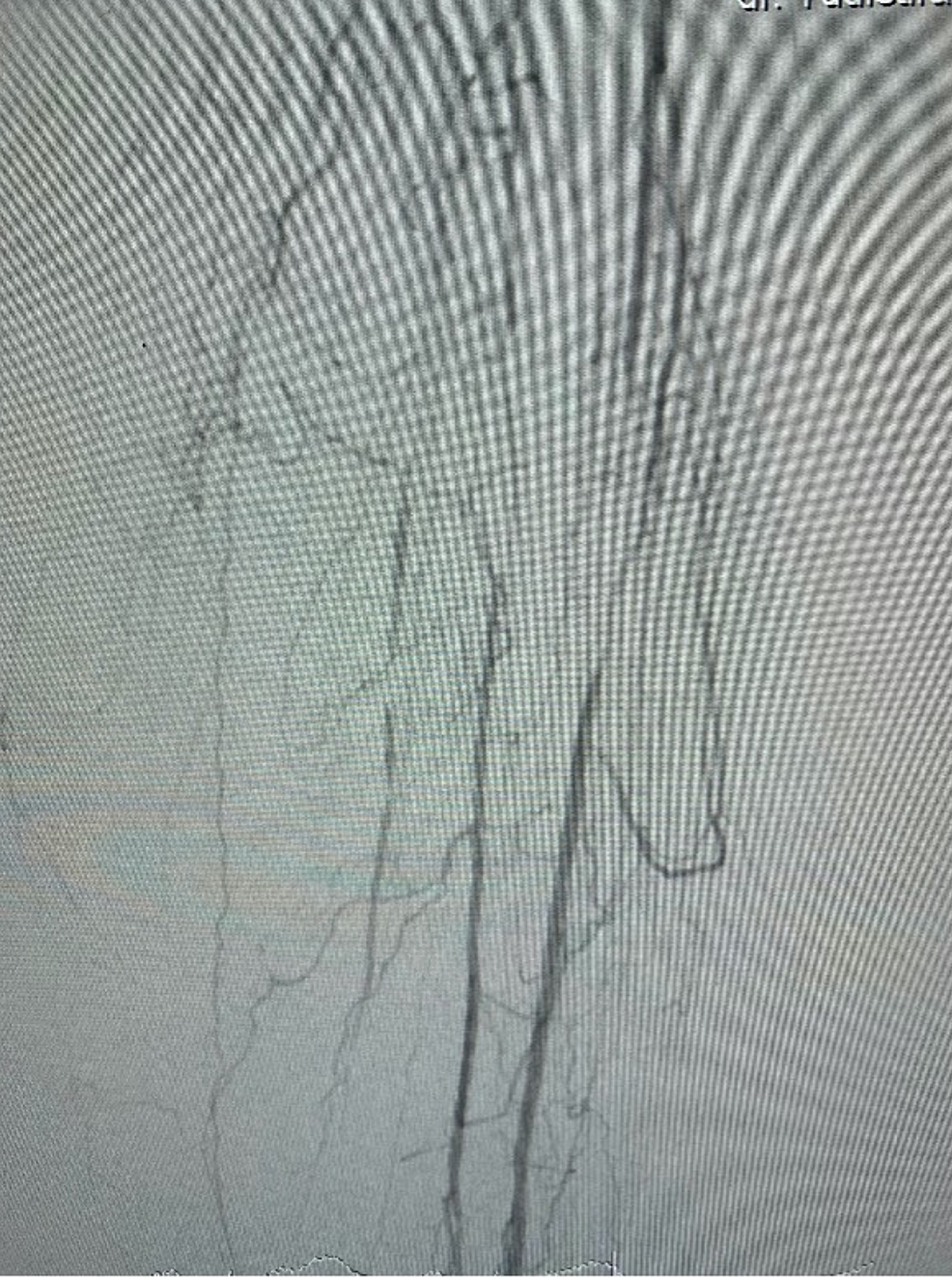 Arteriogram-left-leg-(below-knee)