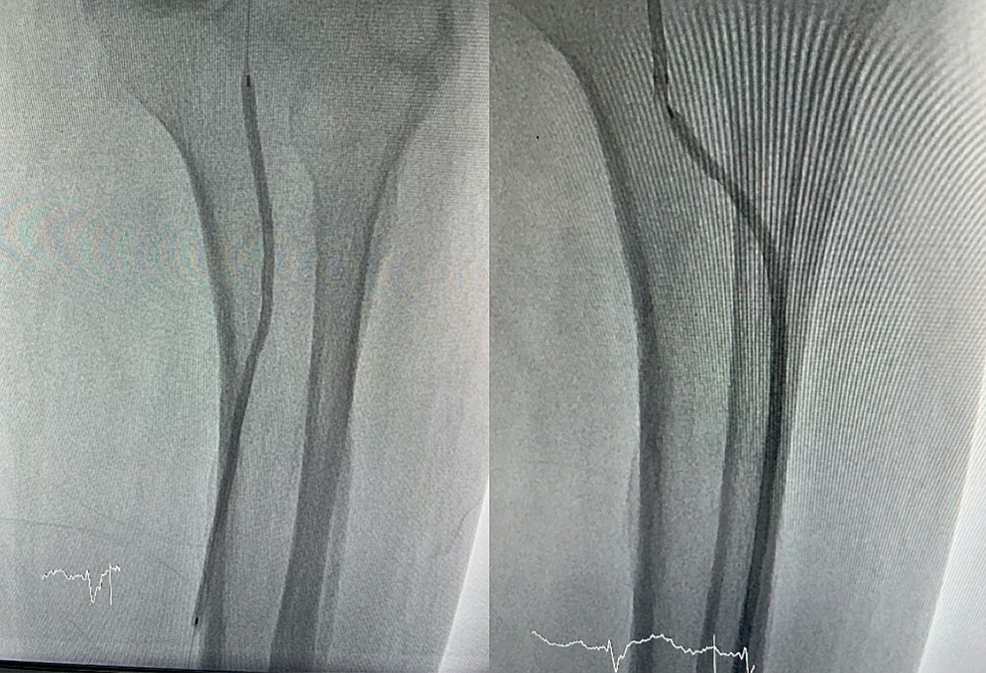 Endovascular-treatment-in-the-left-leg
