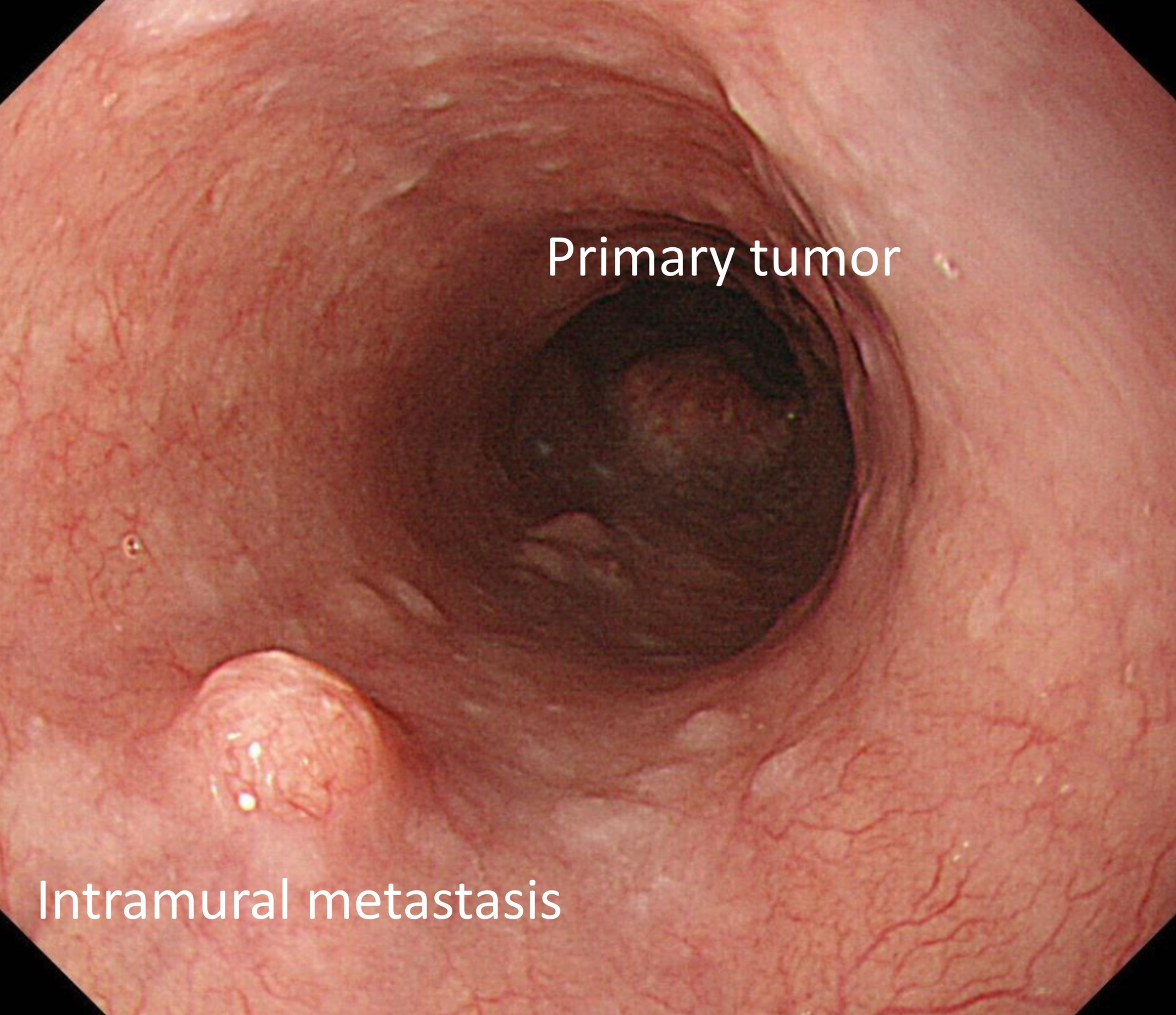 esophagus cancer endoscopy