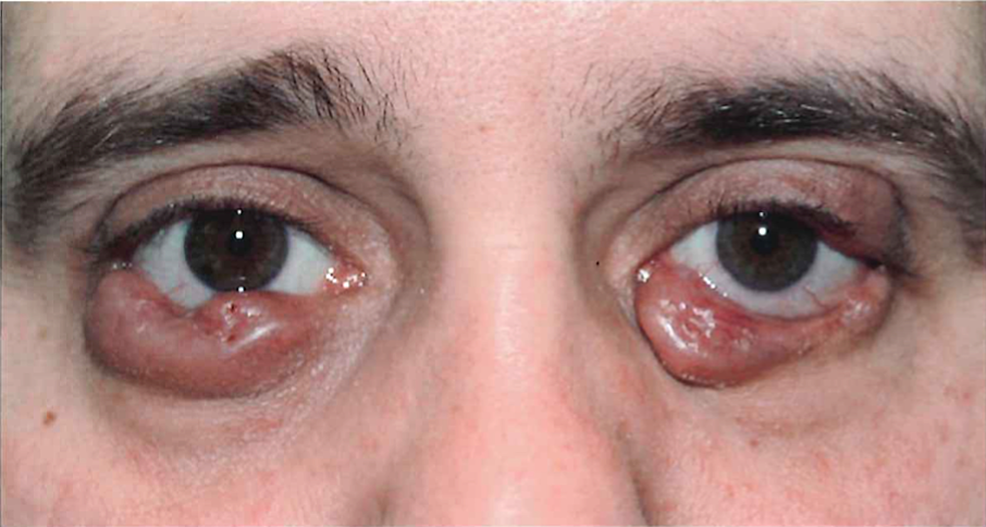 Radiotherapy for Langerhans Cell Histiocytosis of Bilateral Eyelids ...