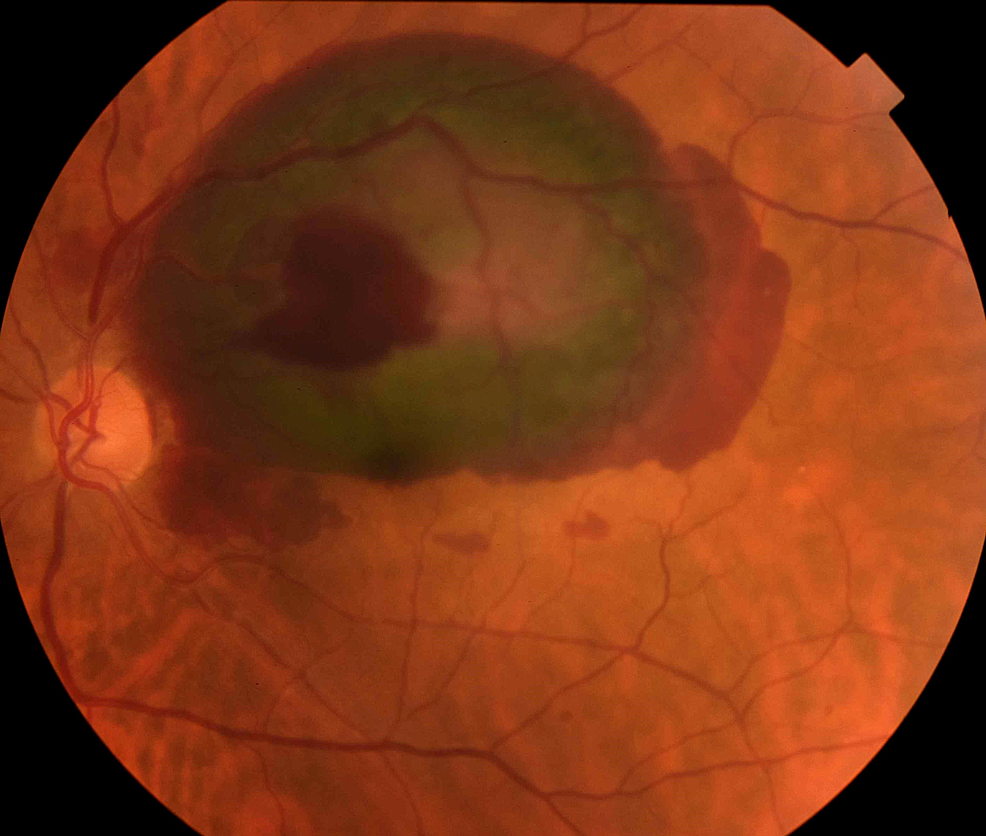 Left-eye-color-fundus-photography-shows-massive-sub-retinal-and-pre-retinal-hemorrhages-in-the-supratemporal-quadrant-and-the macular-area.