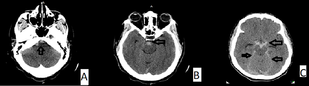 Axial-slides-of-plain-CT-brain-showing-nonaneurysmal-SAH-into-the-prepontine,-perimesencephalic,-and-interpeduncular-cisterns.