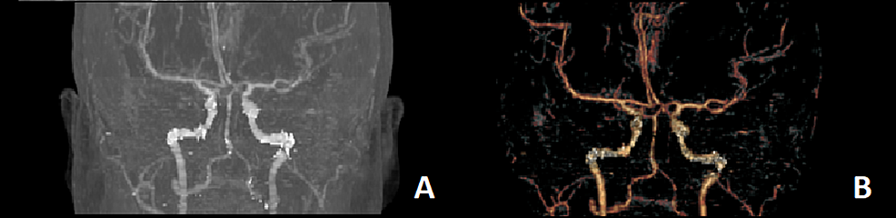 CT-angiography-showing-no-vascular-abnormality-in-the-posterior-circulation.